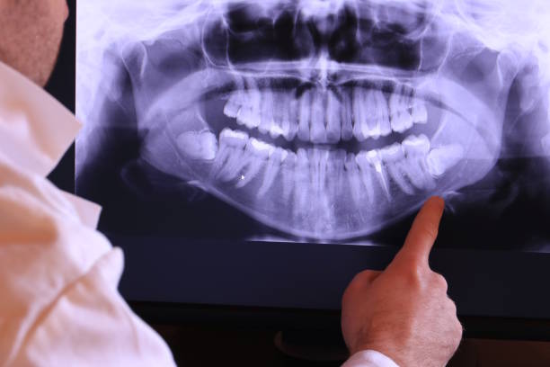 Best Emergency Wisdom Teeth Removal in Limestone Creek, FL